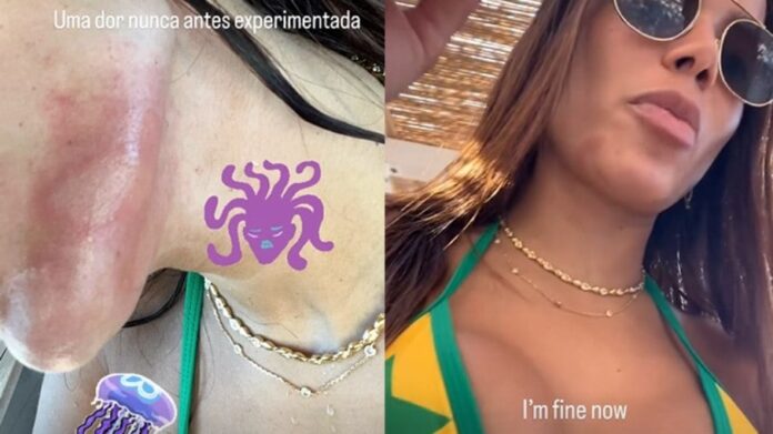 Anitta foi machucada por uma água-viva