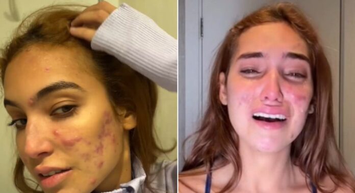 Vanessa Lopes expõe tratamento de acne na web — Foto: Reprodução/Instagram